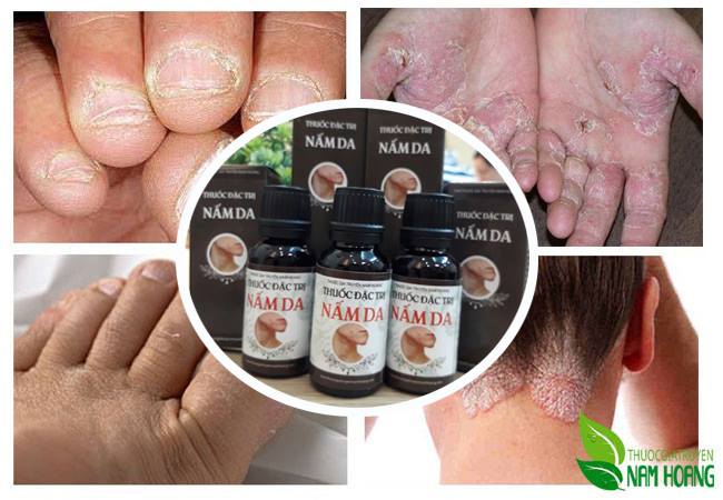Thuốc đặc trị nấm da tốt nhất đang được nhiều người tìm mua