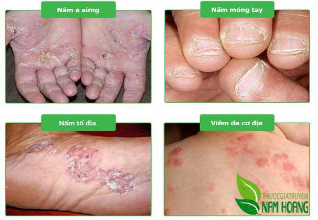 Thuốc đặc trị nấm hiệu quả nhất hiện nay bạn nên biết